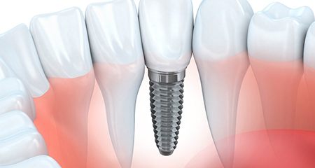 Atasehir Dental Clinic - Dental Implant