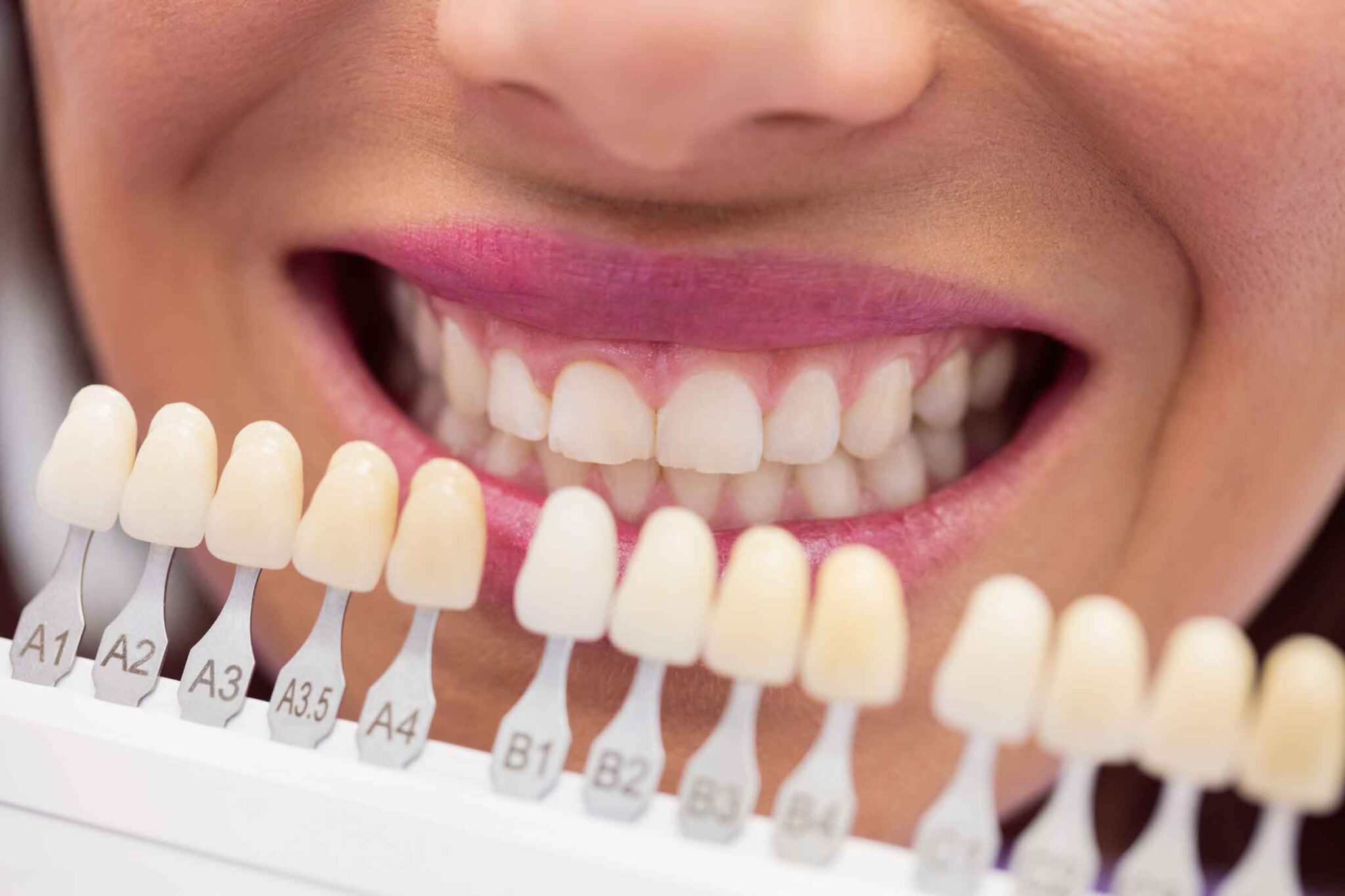 Atasehir Dental Clinic -  Ataşehir Teeth Whitening